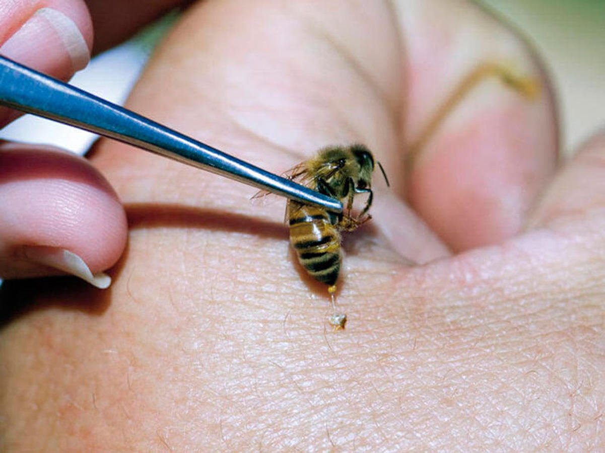 Укус пчелы человека. Шмель пчела Оса Шершень укусы. Пчелиный яд апитерапия.
