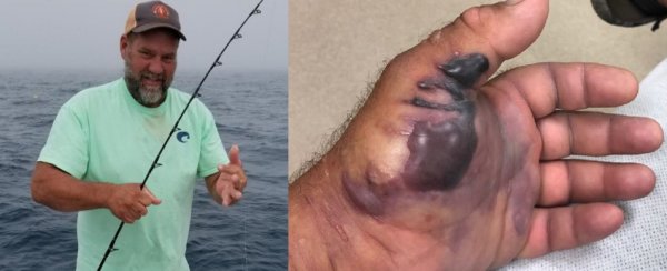 Рыбака из Америки чуть не убила питающаяся плотью бактерия