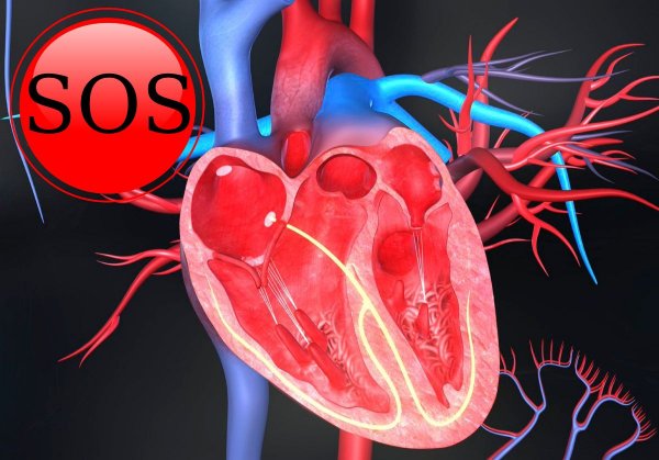 Избыток кальция приводит к открытой операции на сердце  кардиолог